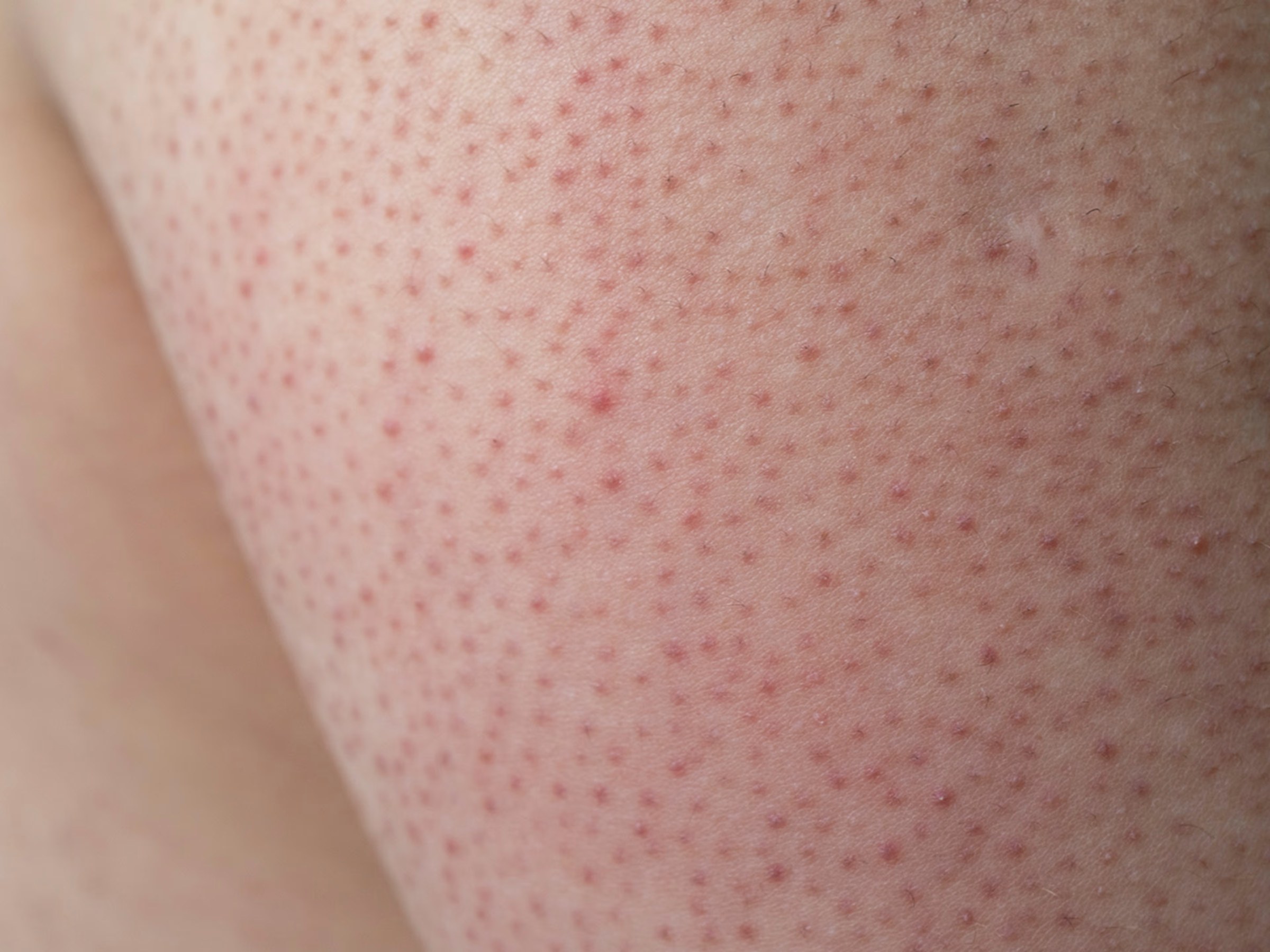 Kératose pilaire : comprendre cette peau râpeuse et comment la traiter