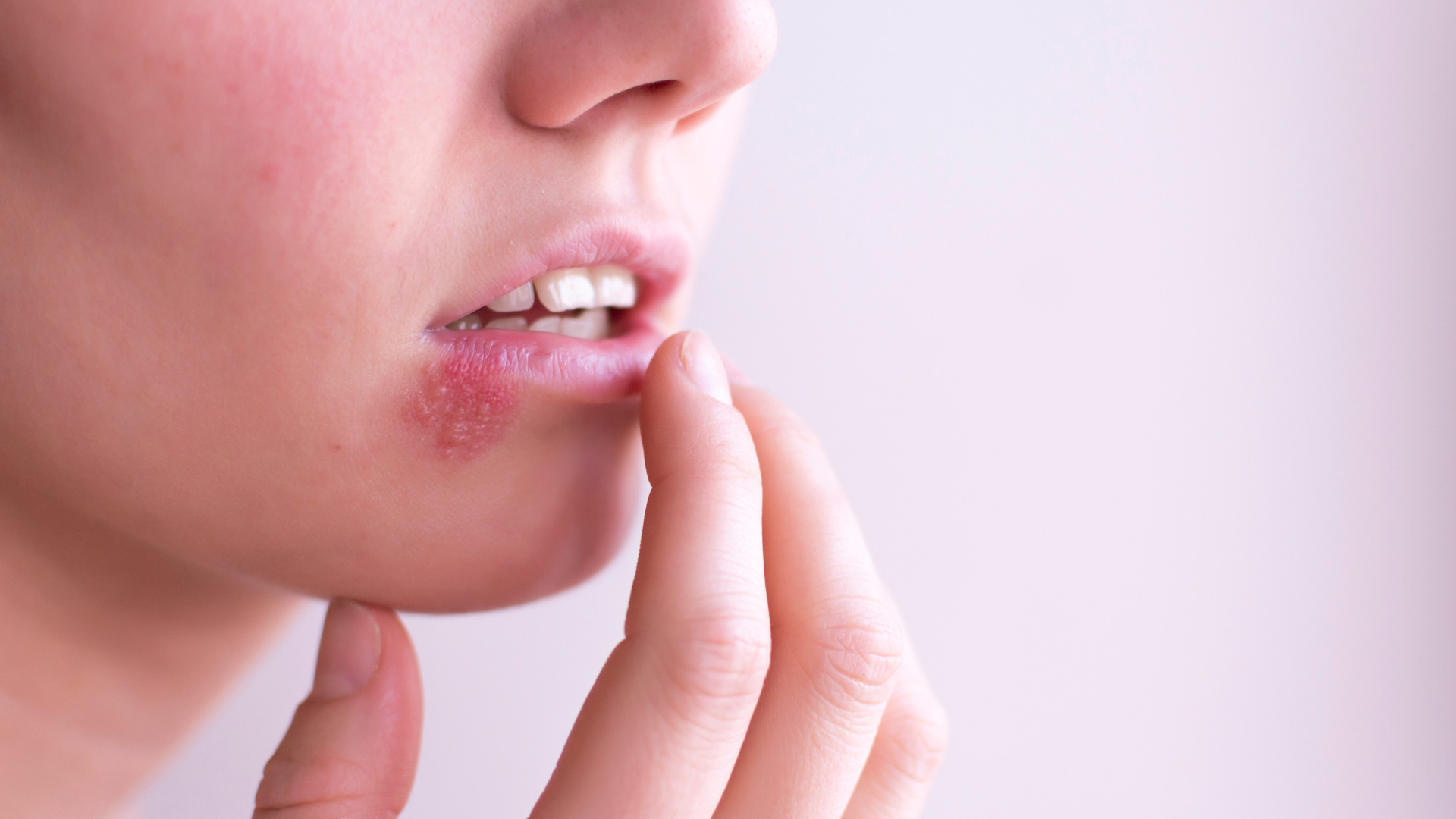 Bouton de fièvre sur la lèvre inférieure, vésicule d'herpès labial